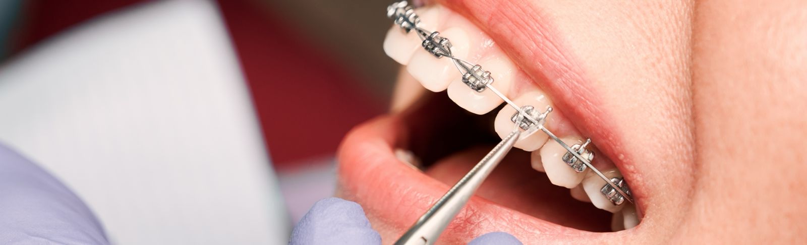 Ortodoncia 1 - Clínica Dental Eurodent